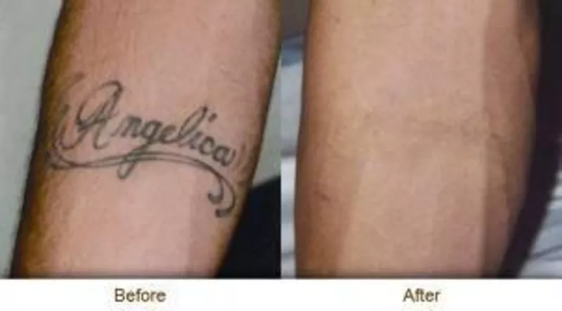 Удаление татуировок и некачественного перманентного макияжа (татуажа) 2